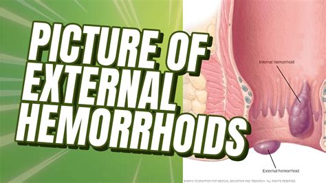 actual pictures of hemorrhoids